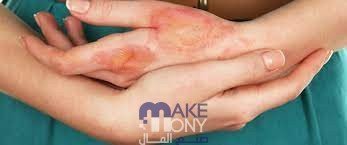 تحدث الحروق الكيميائية بسبب التعرض